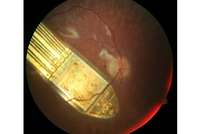 Retinaimplantat